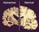 Alzheimer's Effect on the brain